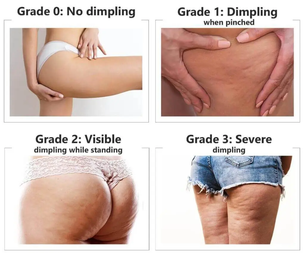 Representation of the stages of cellulite development Bedford